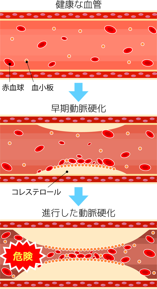 高血圧が続くとどうなる？