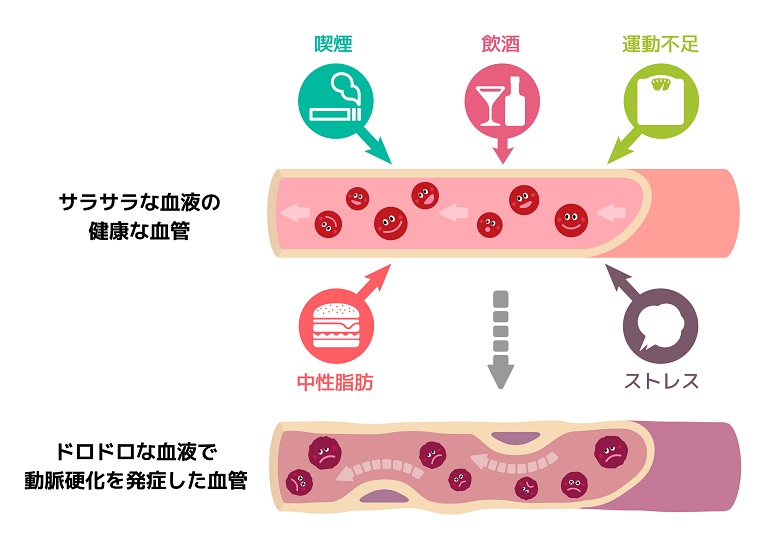 自覚症状がなく進行する動脈硬化