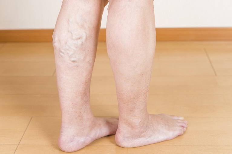 足の静脈が浮き出てくる下肢静脈瘤